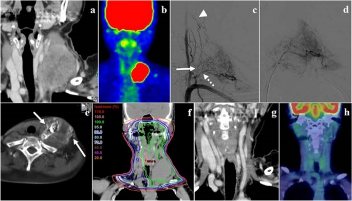 Therapeutic efficacy of selective intra-arterial chemoradiotherapy with  docetaxel and nedaplatin for fixed bulky nodal disease in head and neck  cancer of unknown primary | SpringerLink