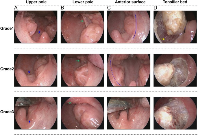 A novel classification and grading scale of palatine tonsil anatomy in  children | SpringerLink