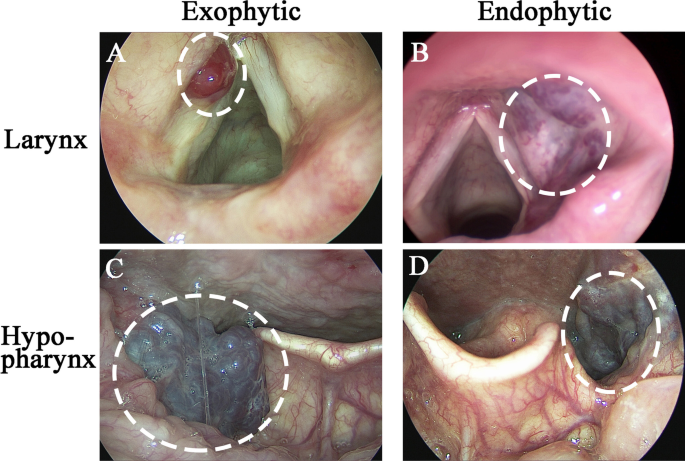 Morphology-guided treatment of adult laryngeal and hypopharyngeal  hemangioma: FD-EENT experience | SpringerLink