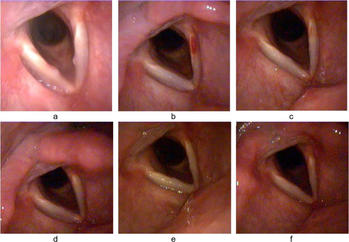 Intralesional steroid injection versus voice therapy for the management of  early vocal fold nodules in female patients: a randomized controlled trial  | European Archives of Oto-Rhino-Laryngology