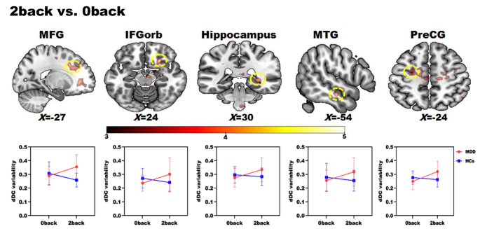 Aberrant brain dynamics in major depressive disorder during working ...