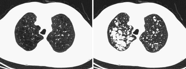 Quantitative Computed Tomography in COPD: Possibilities and ...
