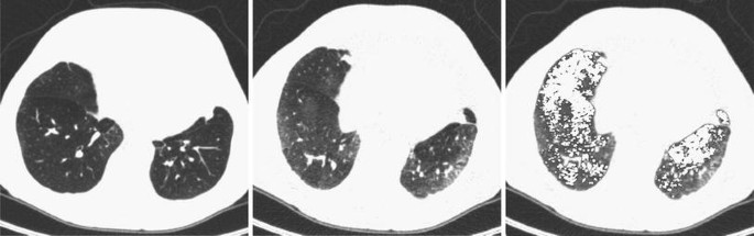 Quantitative Computed Tomography in COPD: Possibilities and ...