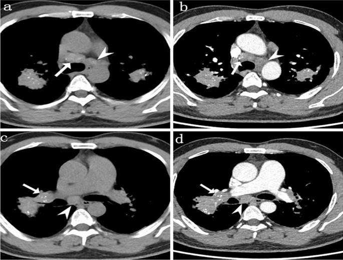 Comparison Of Silicosis And Tuberculosis Involving Mediastinal Lymph Nodes Based On Contrast Enhanced Multidetector Row Computed Tomography Springerlink