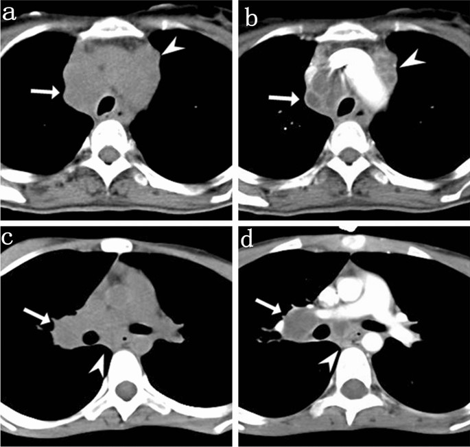 Comparison Of Silicosis And Tuberculosis Involving Mediastinal Lymph Nodes Based On Contrast Enhanced Multidetector Row Computed Tomography Springerlink