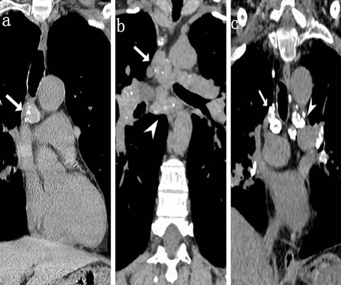 Comparison Of Silicosis And Tuberculosis Involving Mediastinal Lymph Nodes Based On Contrast Enhanced Multidetector Row Computed Tomography Springerlink