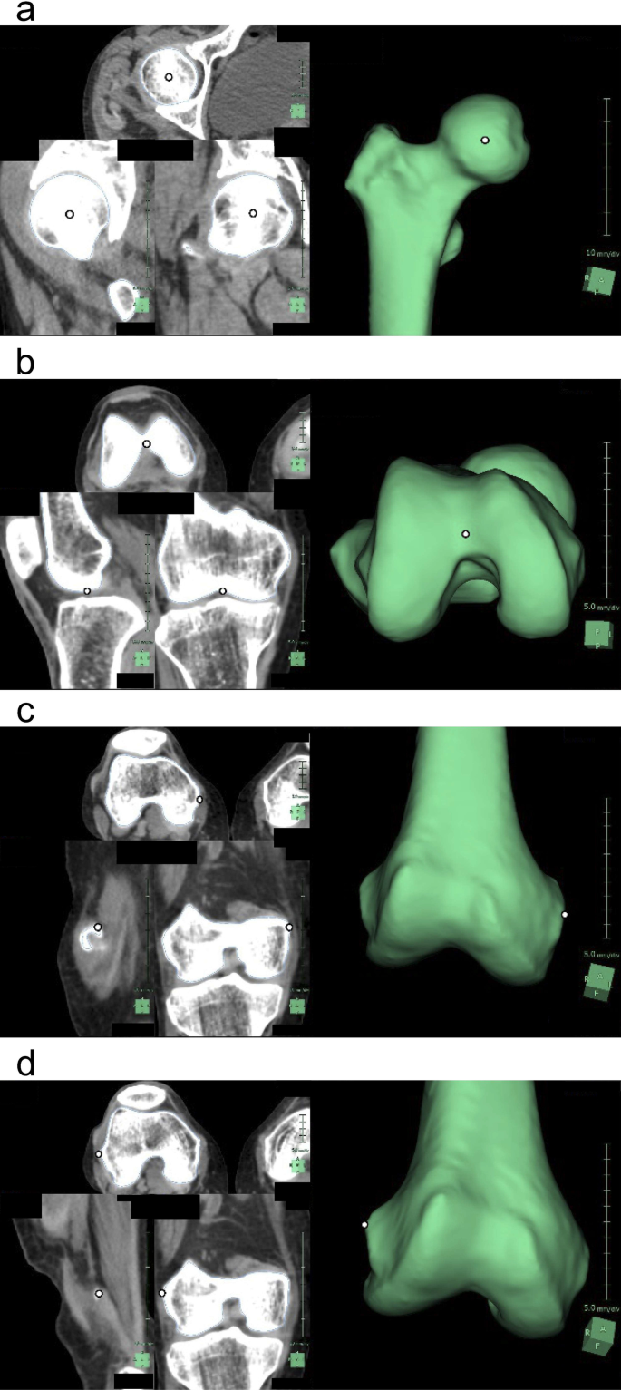 Stature estimation by semi-automatic measurements of 3D CT images of the  femur | International Journal of Legal Medicine