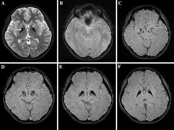 Nigropallidal Iron Accumulation In Pantothenate Kinase Associated Neurodegeneration Demonstrated By Susceptibility Weighted Imaging Springerlink
