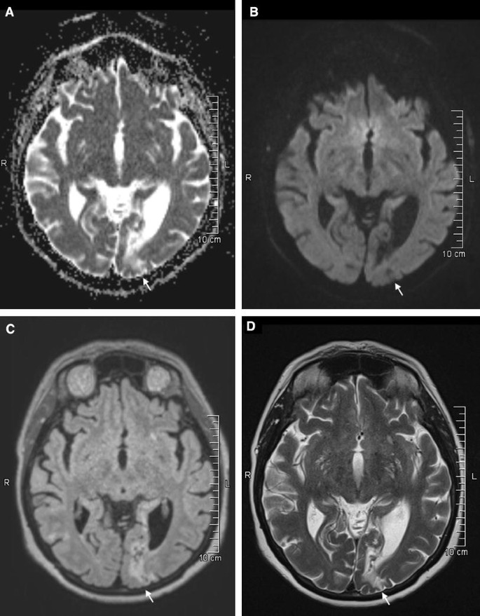 Charles Bonnet syndrome successfully treated with levetiracetam | SpringerLink Charles Bonnet syndrome successfully treated with levetiracetam | SpringerLink