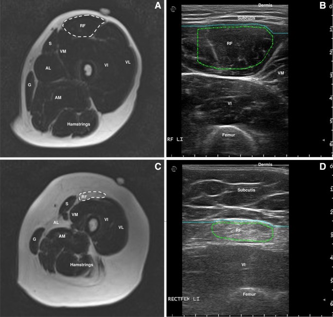 Quantitative Muscle Mri And Ultrasound For Facioscapulohumeral Muscular Dystrophy Complementary Imaging Biomarkers Springerlink