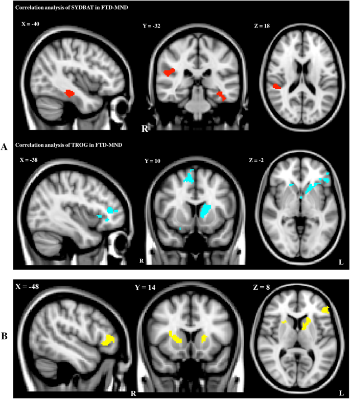 Clinical and neuroimaging investigations of language disturbance ...