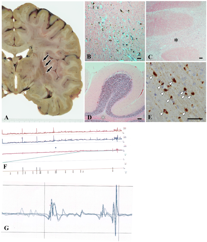 Early Presentation Of Urinary Retention In Multiple System Atrophy Can The Disease Begin In The Sacral Spinal Cord Springerlink