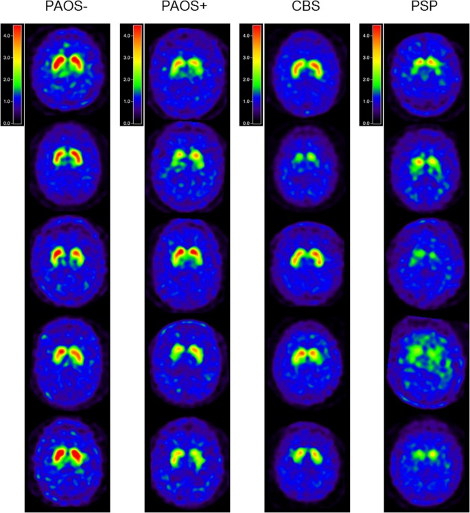 Ioflupane 123I (DAT scan) SPECT identifies dopamine receptor dysfunction  early in the disease course in progressive apraxia of speech | SpringerLink