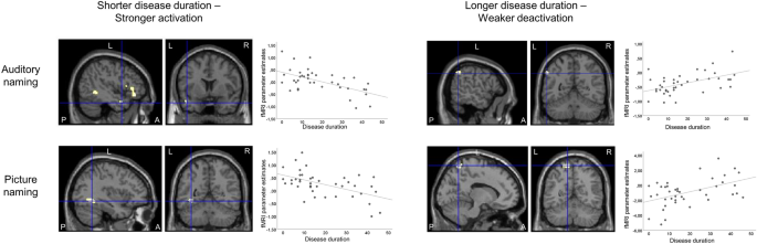 Impaired Naming Performance In Temporal Lobe Epilepsy