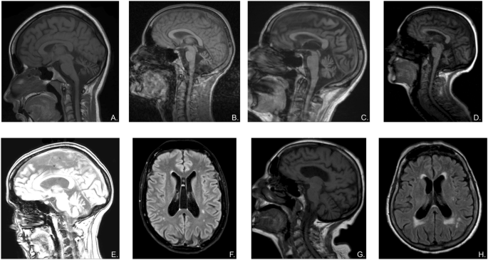 Expanding The Clinical Spectrum Of Stip1 Homology And U Box Containing Protein 1 Associated Ataxia Springerlink