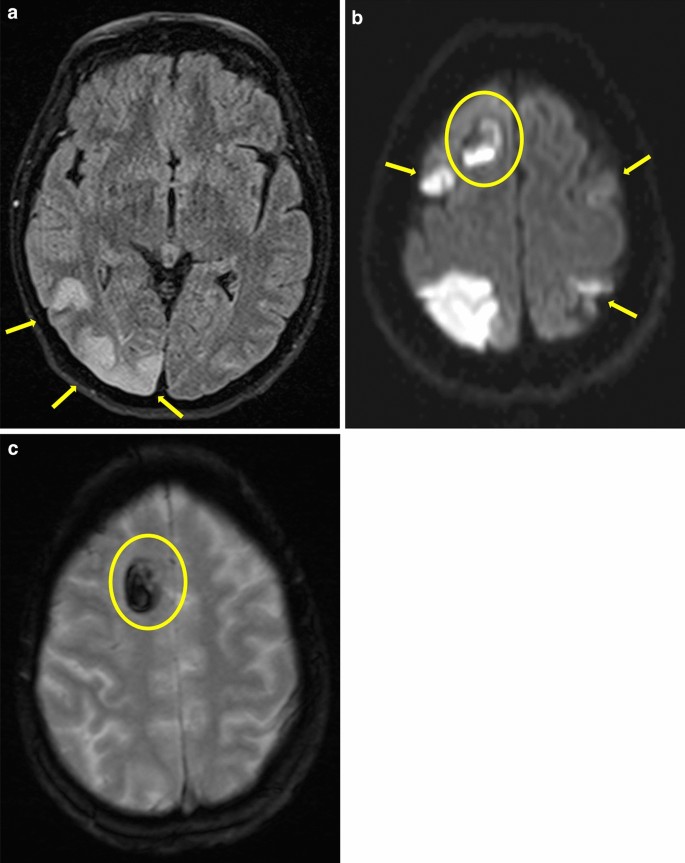 Reversible Cerebral Vasoconstriction Syndrome