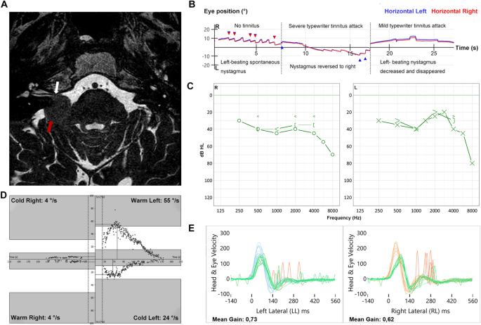 Typewriter tinnitus with time-locked vestibular paroxysmia in a patient with cerebellopontine angle meningioma | Journal of Neurology | Springer Nature Link Typewriter tinnitus with time-locked vestibular paroxysmia in a patient with cerebellopontine angle meningioma | Journal of Neurology | Springer Nature Link