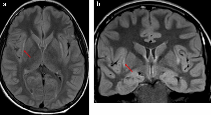 His brain is on FIRES | Journal of Neurology