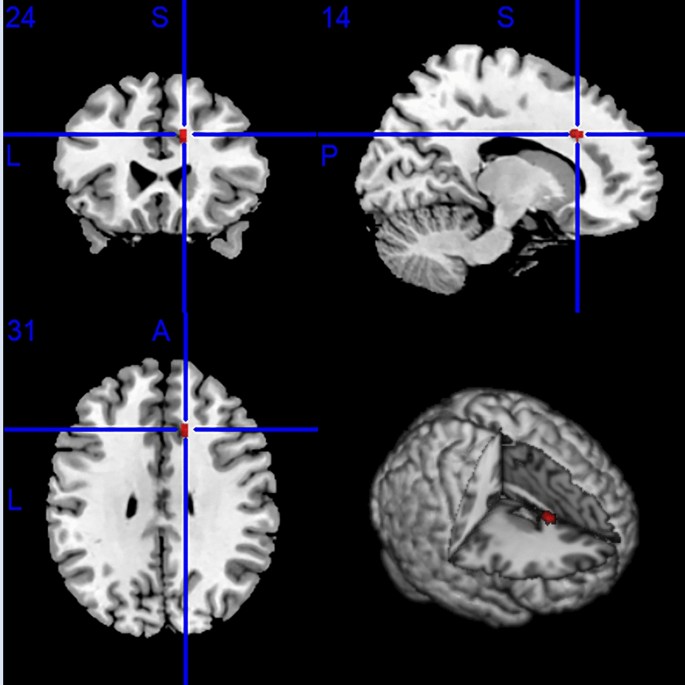 Structural and functional alterations in the brain gray matter among ...