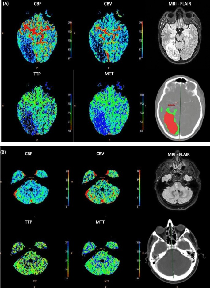 Effectiveness of CT perfusion in posterior circulation stroke ...