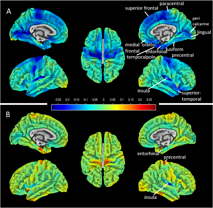 Cortical thinning and white matter alterations in myotonic dystrophy ...