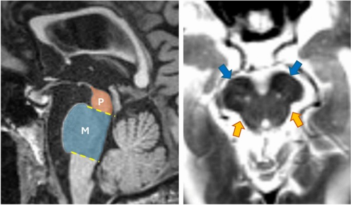 Diagnostic utility of biomarkers in progressive supranuclear palsy ...
