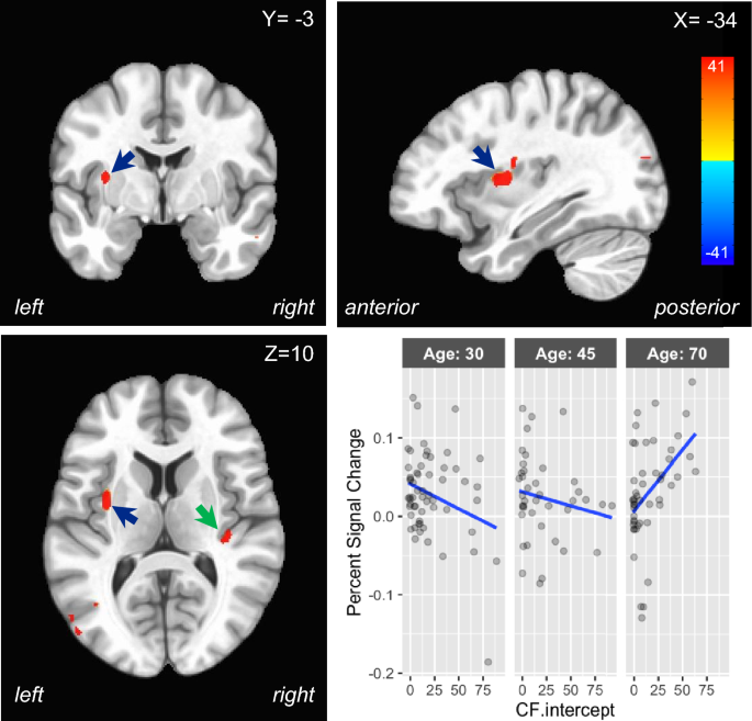 The differential effect of chronological age and brain age on cognitive ...