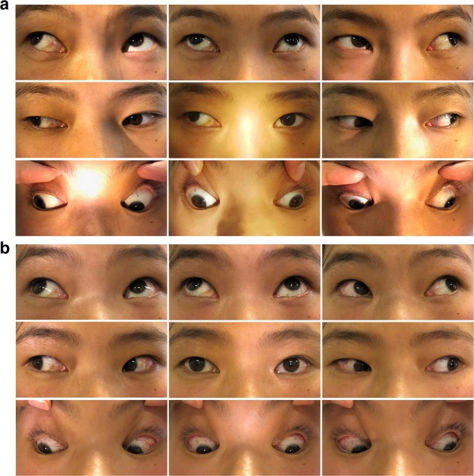 The Stability Of Horizontal Ocular Alignment Of Triad Exotropia