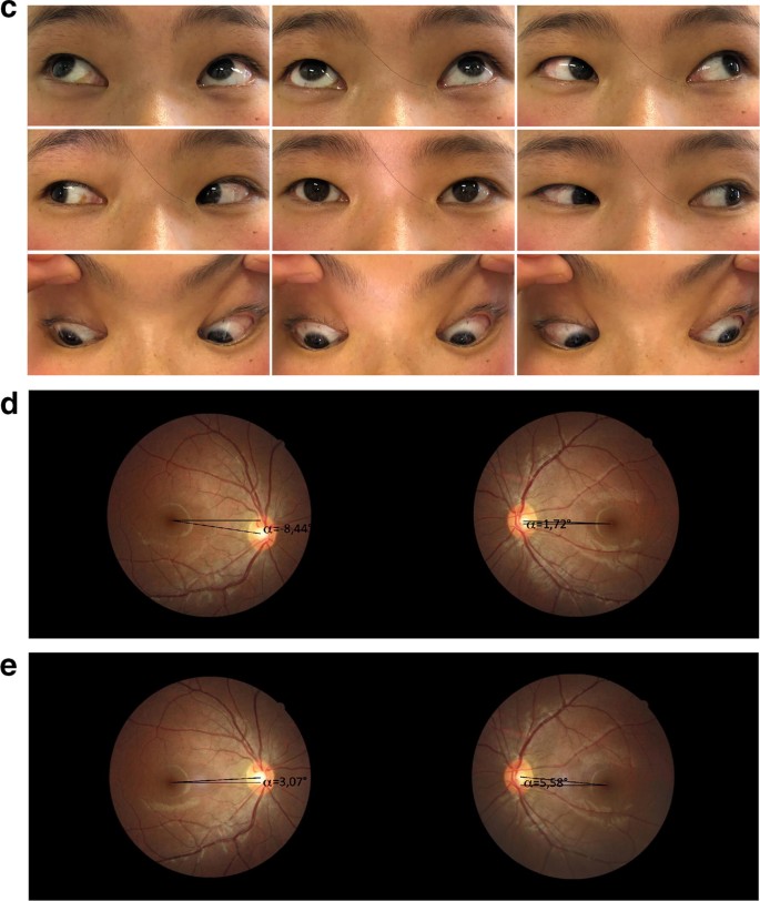 The Stability Of Horizontal Ocular Alignment Of Triad Exotropia