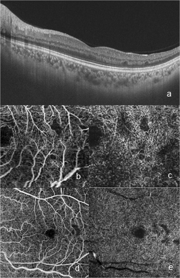 Optical coherence tomography (OCT) and OCT angiography allow early  identification of sickle cell maculopathy in children and correlate it with  systemic risk factors | SpringerLink