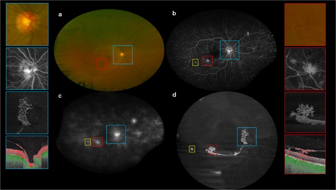 Wide Field Optical Coherence Tomography Angiography For The Detection Of Proliferative Diabetic Retinopathy Springerlink
