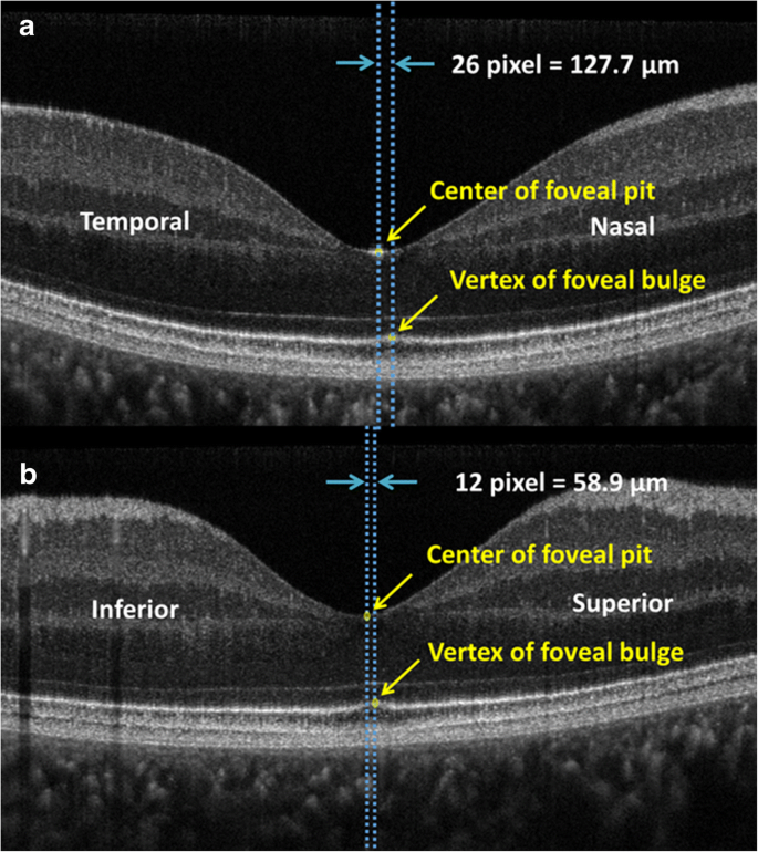 What is the fovea? – Front Range Retina