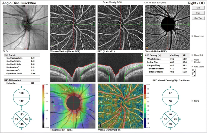 Evaluation Of Microvascular Changes In Retinal Zones And Optic Disc In Pediatric Patients With Type 1 Diabetes Mellitus Springerlink