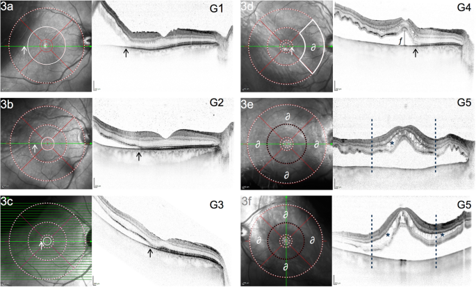 Functional Recovery After Macula Involving Retinal Detachment And Its Correlation With Preoperative Biomarkers In Optical Coherence Tomography Springerlink