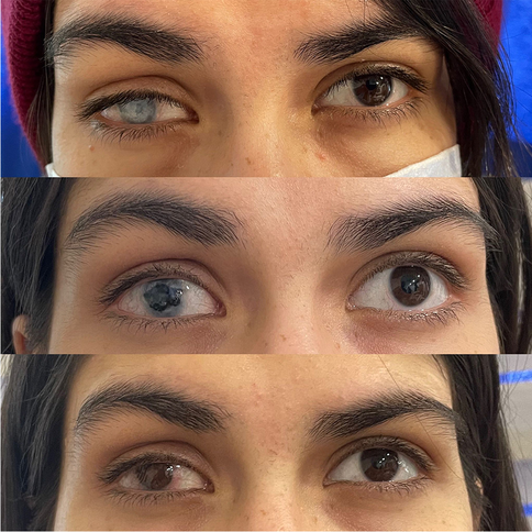 Ottawa woman who got botched eyeball tattoo Id rather get my eye taken  out  National  Globalnewsca