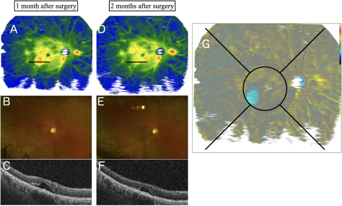 Retinal morphological changes detected by wide-field optical coherence ...