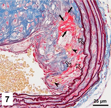 Combined orcein and martius scarlet blue (OMSB) staining for qualitative  and quantitative analyses of atherosclerotic plaques in brachiocephalic  arteries in apoE/LDLR−/− mice | Histochemistry and Cell Biology