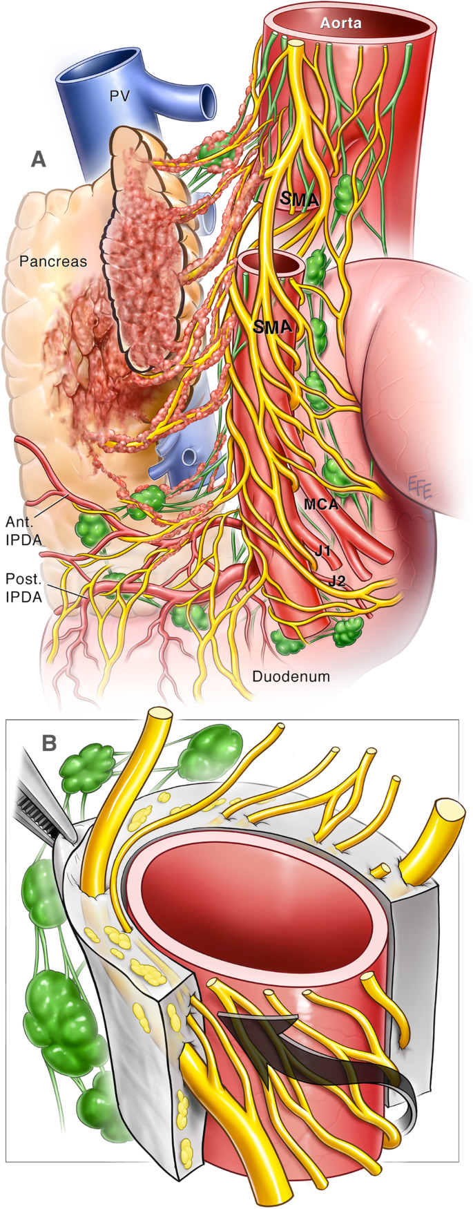 Mesenteric Ischemia | Concise Medical Knowledge, image size:685x1750