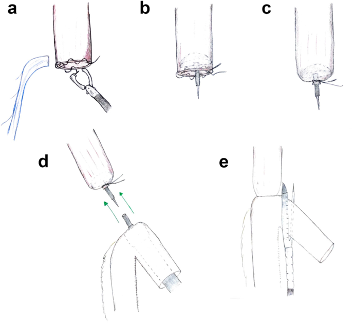 End-to-side circular stapled versus side-to-side linear stapled  intrathoracic esophagogastric anastomosis following minimally invasive  Ivor–Lewis esophagectomy: comparison of short-term outcomes | SpringerLink