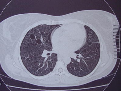 Lung disease 35 years after aspiration of activated charcoal in combination  with pulmonary lymphangioleiomyomatosis | Virchows Archiv