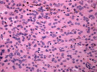 Psammomatous melanotic schwannoma presenting as colonic polyps | Virchows  Archiv