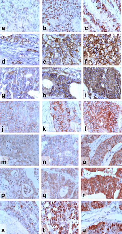 Value of staining intensity in the interpretation of immunohistochemistry  for tumor markers in colorectal cancer | Virchows Archiv