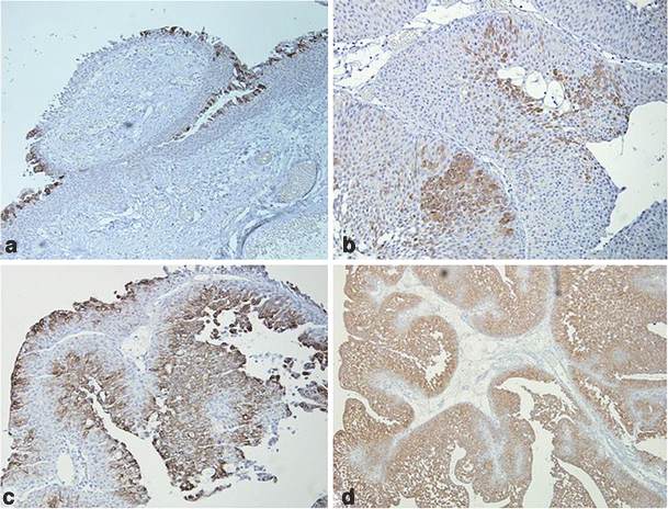 urothelialis papilloma ck20 pinwormok életre kelnek