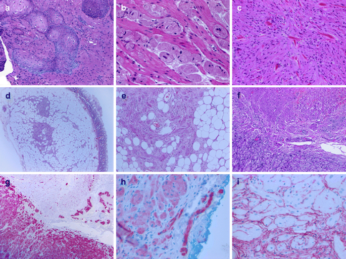 Peripheral nerve sheath tumors of the gastrointestinal tract: a multicenter  study of 58 patients including NF1-associated gastric schwannoma and  unusual morphologic variants | Virchows Archiv