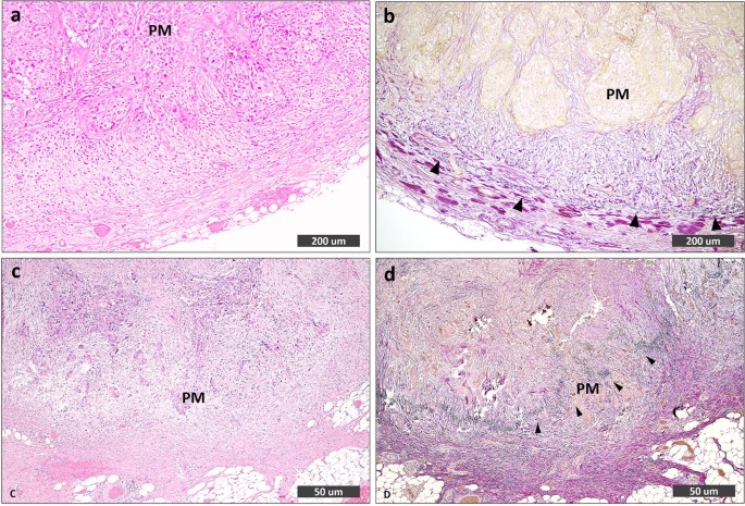 The Effect Of The Peritoneal Tumor Microenvironment On Invasion Of Images, Photos, Reviews
