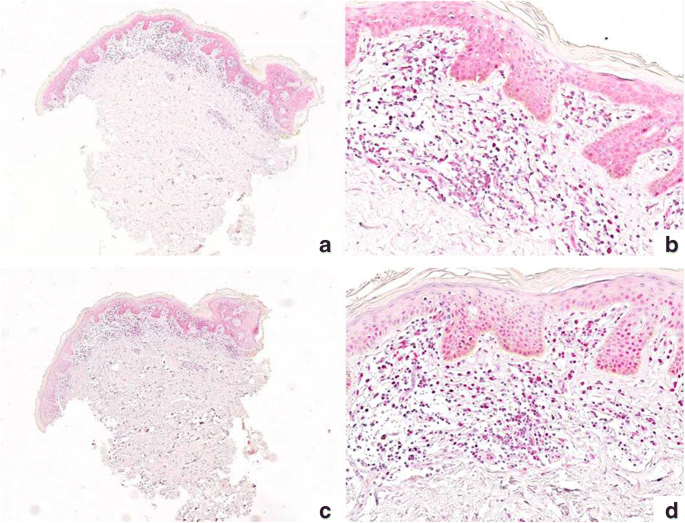 Role Of Chromatin Assembly Factor 1 P60 And Poly Adp Ribose Polymerase 1 In Mycosis Fungoides Springerlink