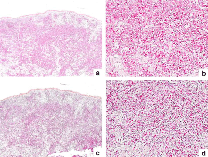 Role Of Chromatin Assembly Factor 1 P60 And Poly Adp Ribose Polymerase 1 In Mycosis Fungoides Springerlink