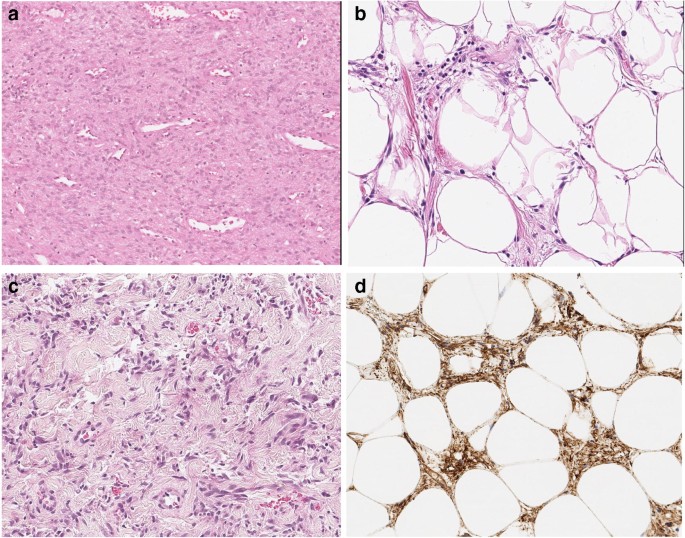 spindle cells and ropey collagen- found in spindle cell lipomas