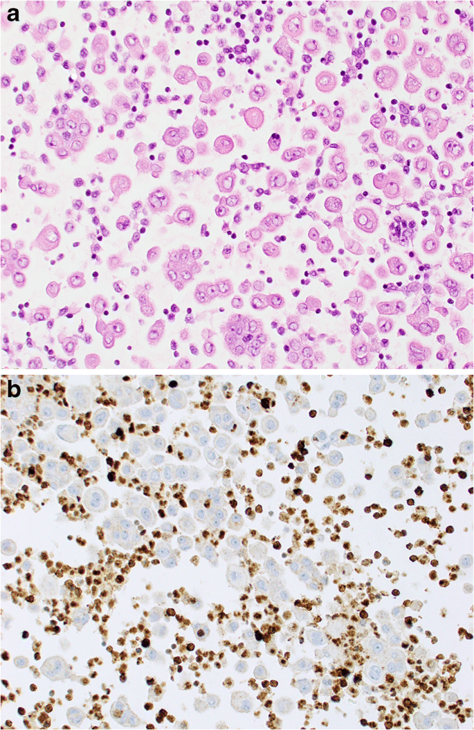 Pleural Mesothelioma Classification Update Springerlink