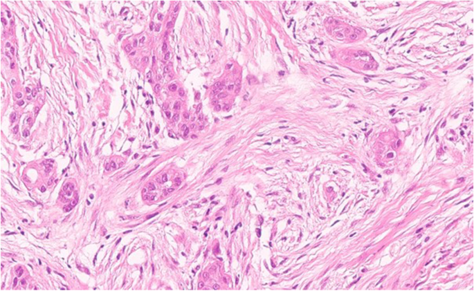 Breast carcinomas of low malignant potential | SpringerLink
